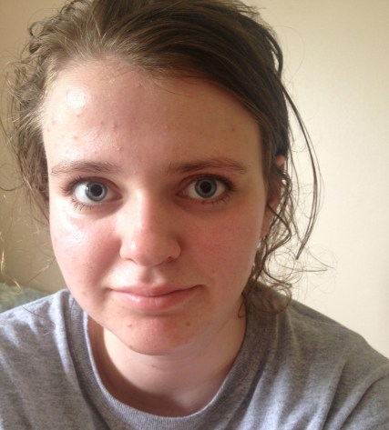 Me without makeup. If anyone was curious the breakouts on my forehead were Cetaphil-induced. My skin looks a wee bit better than this most of the time now!